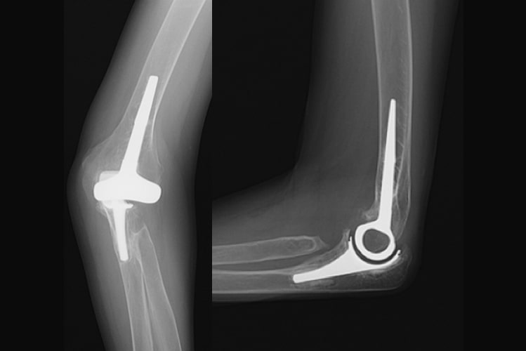表面置換型人工肘関節写真