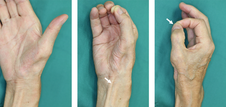 手根管開放術と母指対立再建術 (Camitz変法) の術後