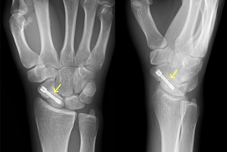 舟状骨骨折術後写真