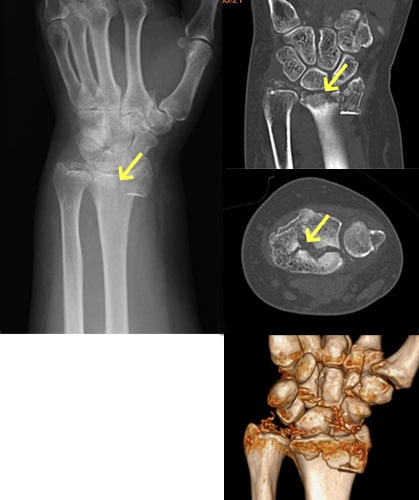 橈骨遠位端骨折写真
