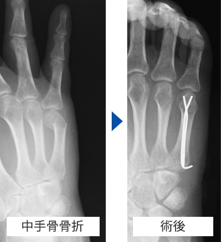 中手骨骨折 術前・術後写真