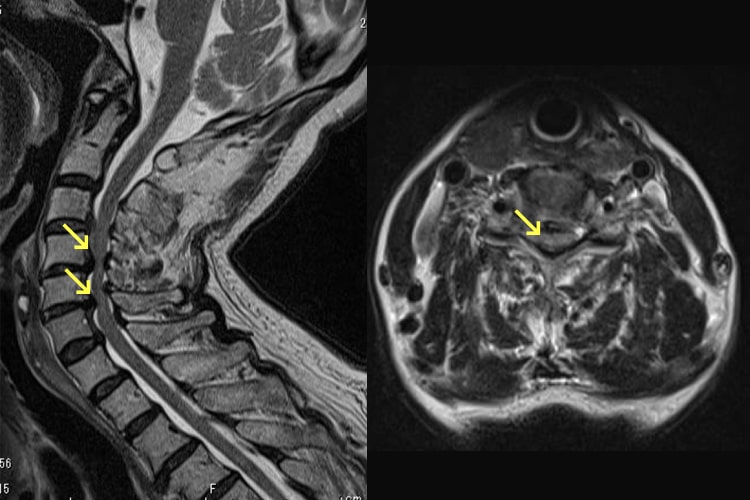 頚椎症性脊髄症写真