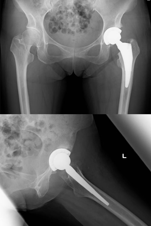 変形性股関節症術後写真