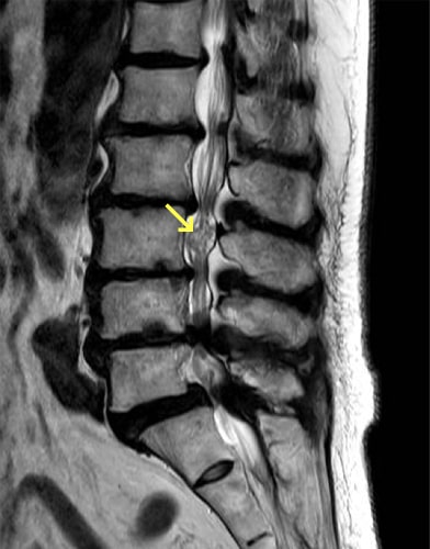 腰部脊柱管狭窄症写真1