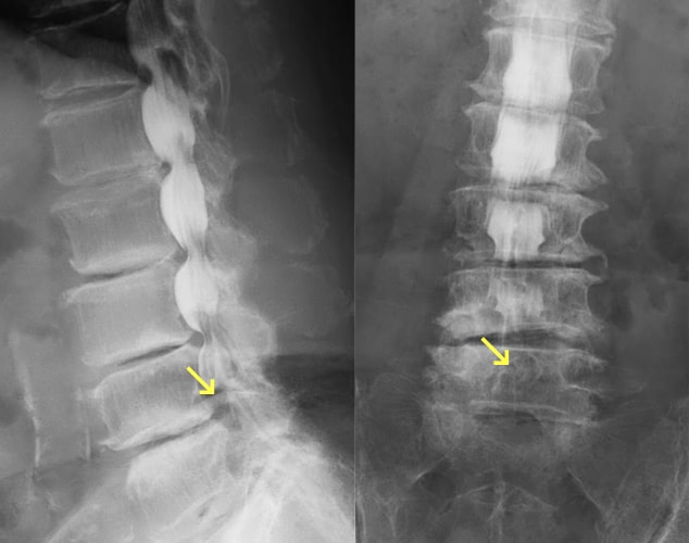 腰部脊柱管狭窄症写真2