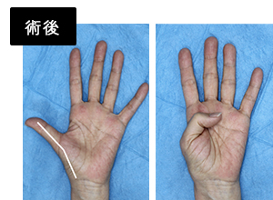 母指CM関節形成術