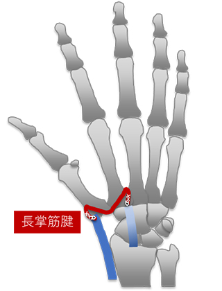 長掌筋腱を用いたThompson変法